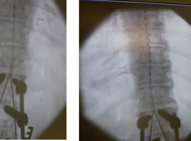 Die Elektroden werden unter Röntgendurchleuchtung in die Mitte des Spinalkanals gelegt, versetzt zu einander.